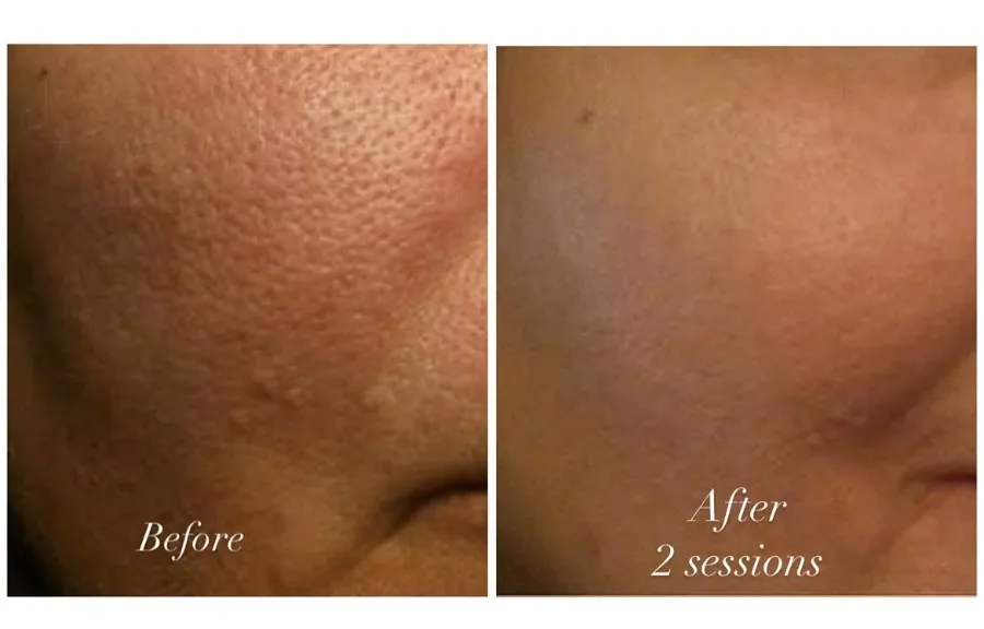 Acne & Pores