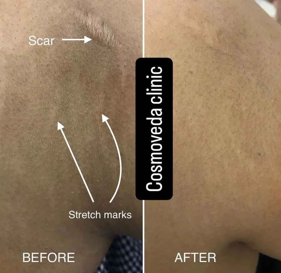 Stretch Marks